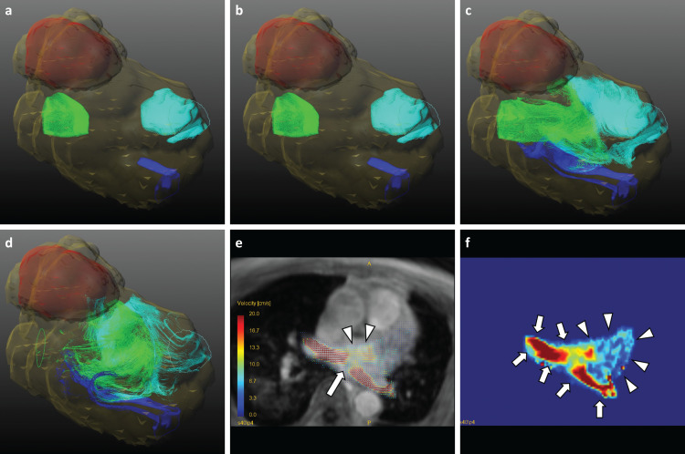 Dual-VENC 4D Flow MRI Can Detect Abnormal Blood Flow in the Left Atrium That Potentially Causes Thrombosis Formation after Left Upper Lobectomy.