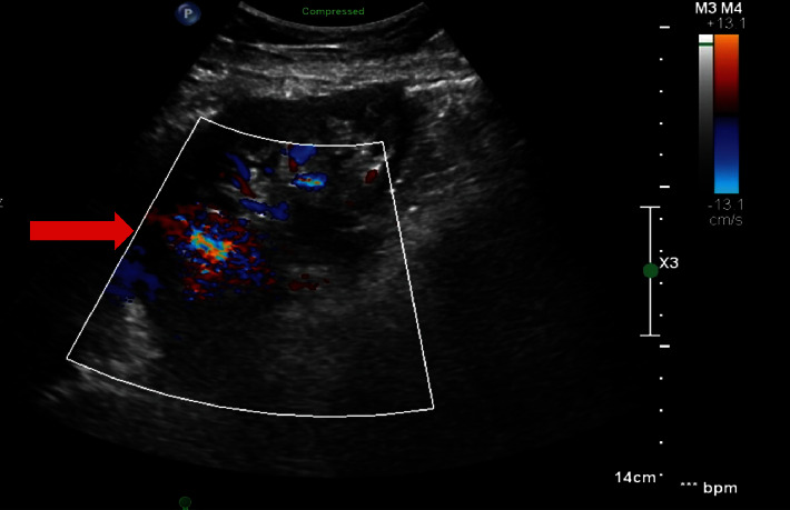 Postoperative and Recurrent Hematuria after Pretransplant Core Needle Biopsy in Living Donor Kidney Transplant.