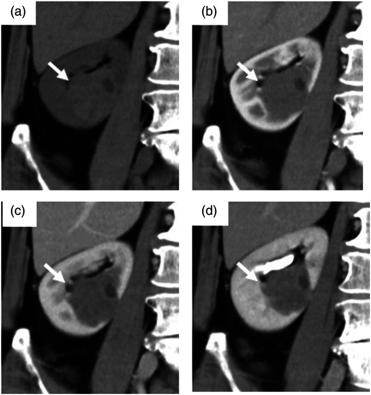 Mixed epithelial and stromal tumor of the kidney composed mainly of solid components: A case report.