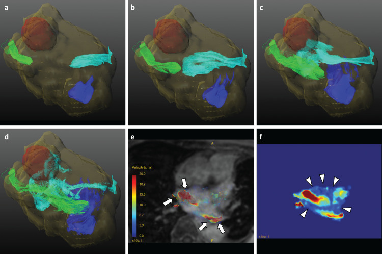 Dual-VENC 4D Flow MRI Can Detect Abnormal Blood Flow in the Left Atrium That Potentially Causes Thrombosis Formation after Left Upper Lobectomy.