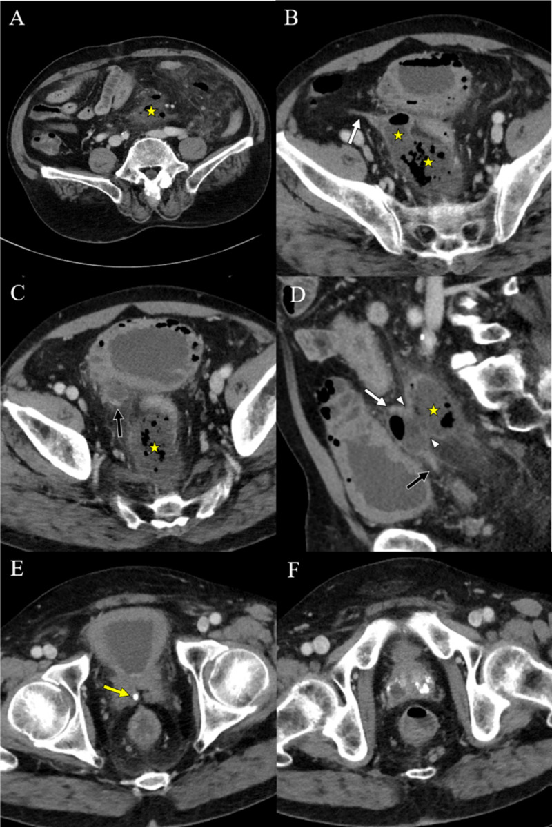 Vas Deferens Abscess Rupture: A Case Report.