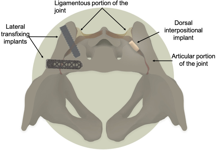 Revision of Failed Sacroiliac Joint Posterior Interpositional Structural Allograft Stabilization with Lateral Porous Titanium Implants: A Multicenter Case Series.