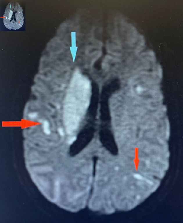 A Unique Case of Tri-Valvular <i>Serratia marcescens</i> Infective Endocarditis Complicated by Innumerable Emboli.