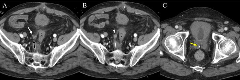 Vas Deferens Abscess Rupture: A Case Report.