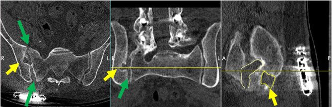 Revision of Failed Sacroiliac Joint Posterior Interpositional Structural Allograft Stabilization with Lateral Porous Titanium Implants: A Multicenter Case Series.