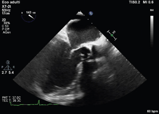 Aortic Biological Prosthetic Valve Dysfunction Secondary to Endocarditis: Is Percutaneous Valve-in-Valve an Option?