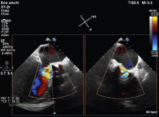 Aortic Biological Prosthetic Valve Dysfunction Secondary to Endocarditis: Is Percutaneous Valve-in-Valve an Option?