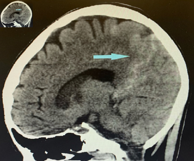 A Unique Case of Tri-Valvular <i>Serratia marcescens</i> Infective Endocarditis Complicated by Innumerable Emboli.