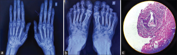 Peripheral gangrene secondary to vasculitis: A rare extra-articular manifestation of rheumatoid arthritis.