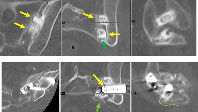 Revision of Failed Sacroiliac Joint Posterior Interpositional Structural Allograft Stabilization with Lateral Porous Titanium Implants: A Multicenter Case Series.