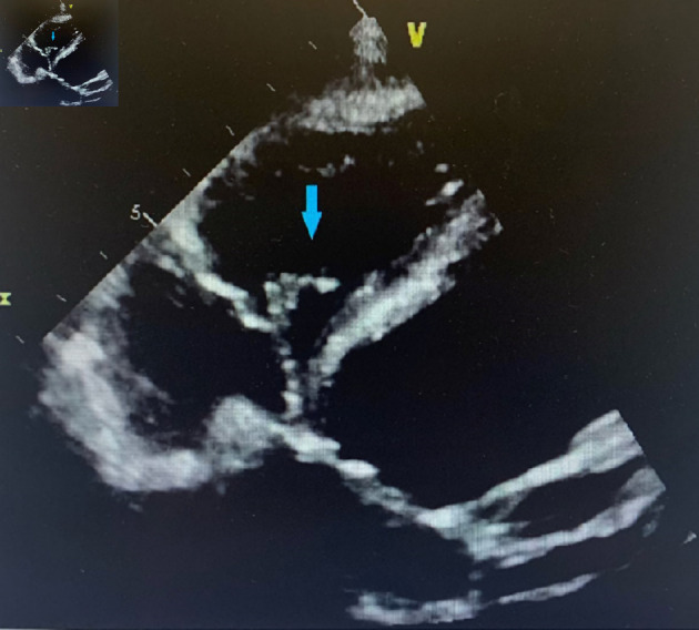 A Unique Case of Tri-Valvular <i>Serratia marcescens</i> Infective Endocarditis Complicated by Innumerable Emboli.