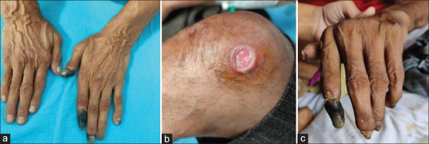 Peripheral gangrene secondary to vasculitis: A rare extra-articular manifestation of rheumatoid arthritis.