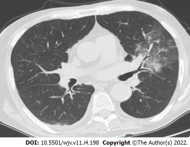 COVID-19 presenting with persistent hiccup and myocardial infarction in a peritoneal dialysis patient: A case report.