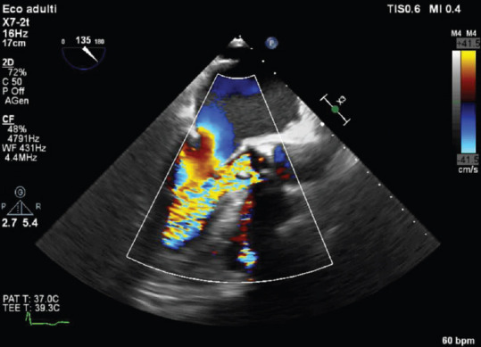 Aortic Biological Prosthetic Valve Dysfunction Secondary to Endocarditis: Is Percutaneous Valve-in-Valve an Option?