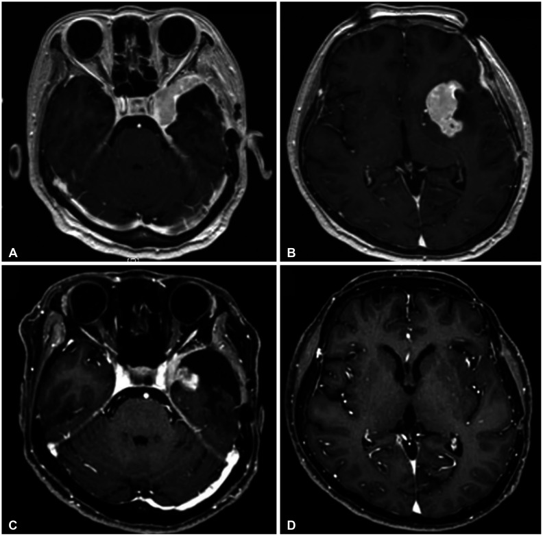 A Huge Radiation-Induced Cavernous Hemangioma Following Stereotactic Radiosurgery for Meningioma: A Case Report.