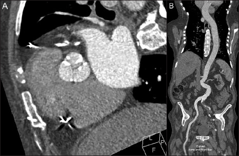 Optimizing low contrast volume thoracic CT angiography: From the basics to the advanced.