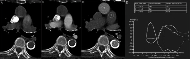 Optimizing low contrast volume thoracic CT angiography: From the basics to the advanced.