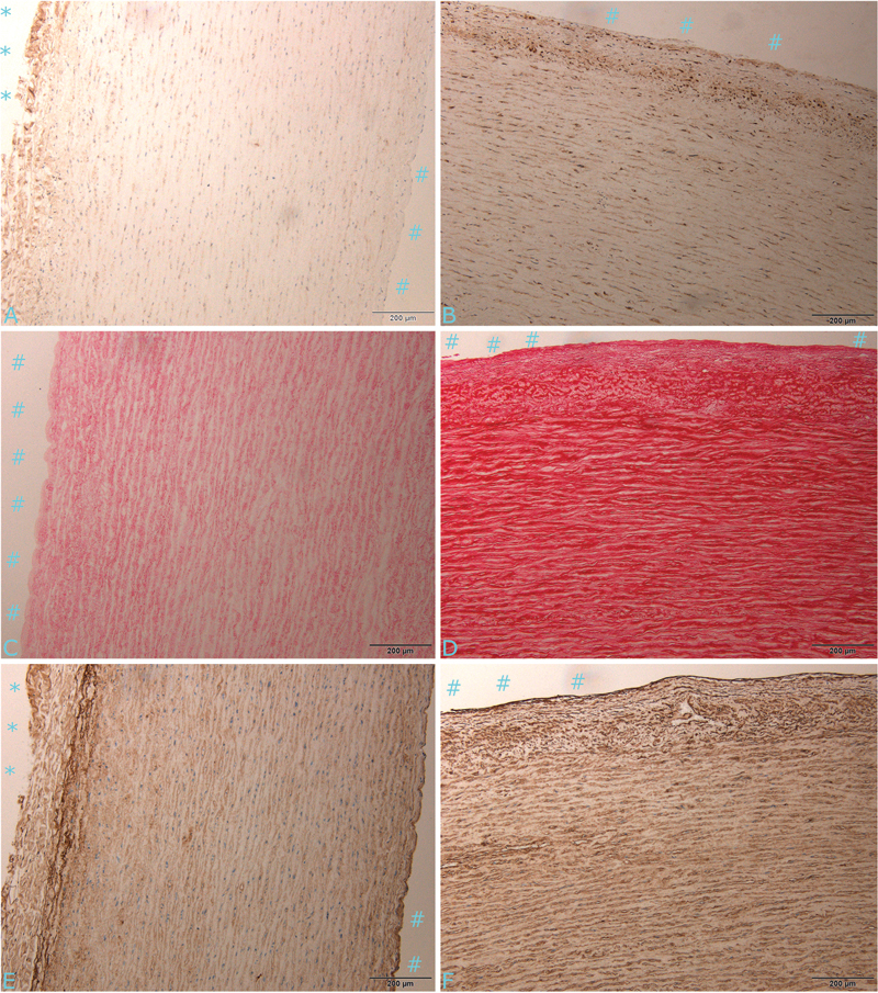 Two Cases of Quadricuspid Aortic Valve: Aortic Regurgitation and Degeneration.