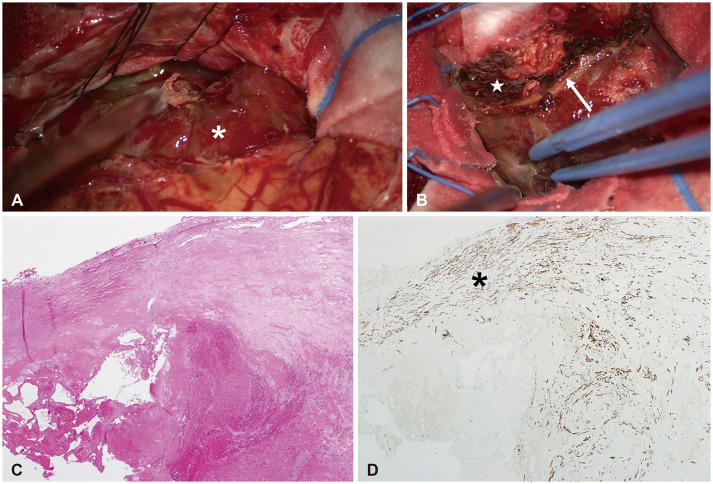 A Huge Radiation-Induced Cavernous Hemangioma Following Stereotactic Radiosurgery for Meningioma: A Case Report.