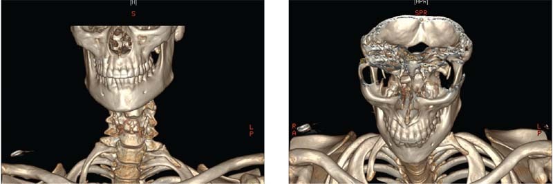 Bilateral Thoracic Outlet Syndrome from Anomalous 8th Cervical Vertebrae Ribs.