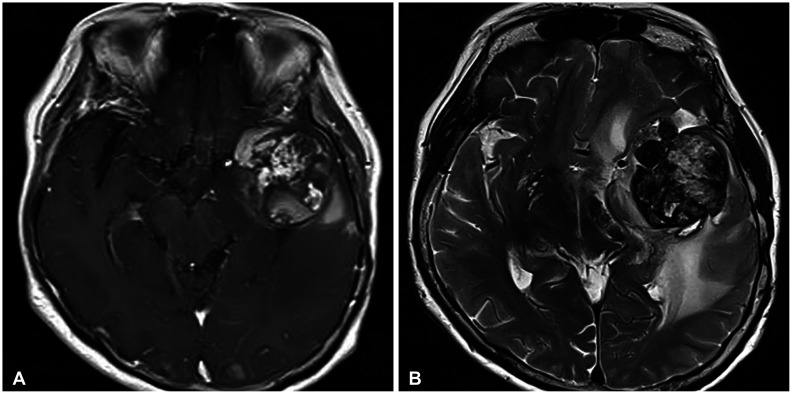 A Huge Radiation-Induced Cavernous Hemangioma Following Stereotactic Radiosurgery for Meningioma: A Case Report.