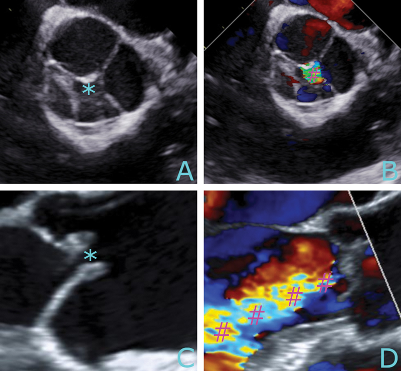 Two Cases of Quadricuspid Aortic Valve: Aortic Regurgitation and Degeneration.