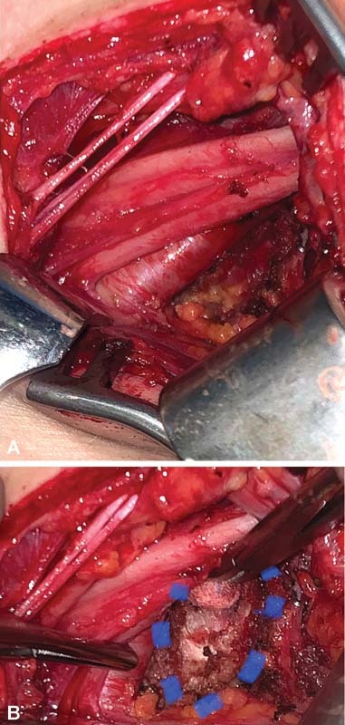 Bilateral Thoracic Outlet Syndrome from Anomalous 8th Cervical Vertebrae Ribs.