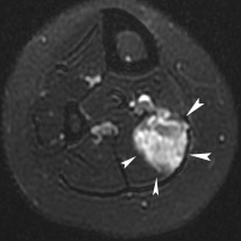 Long-Term Outcome of Single-Session, Ultrasound-Guided, Radiofrequency Ablation for Symptomatic Small, Lower Limb, Venous Malformations.