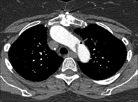 Optimizing low contrast volume thoracic CT angiography: From the basics to the advanced.