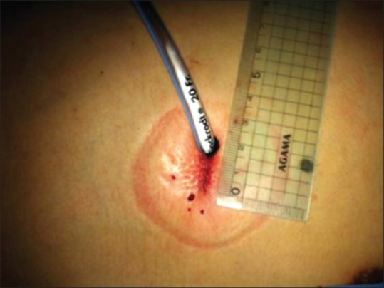 A pilot study of intraoperative intercostal nerve block during uniportal thoracoscopic wedge resection of the lung.