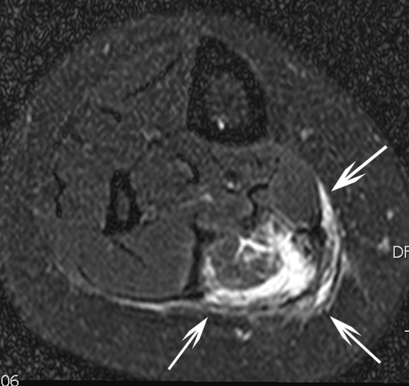 Long-Term Outcome of Single-Session, Ultrasound-Guided, Radiofrequency Ablation for Symptomatic Small, Lower Limb, Venous Malformations.