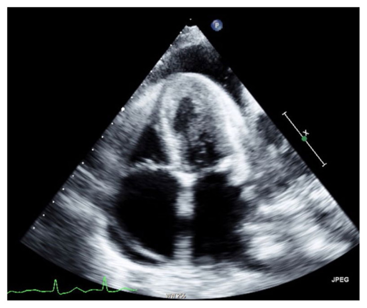 Scleroderma as an Uncommon Cause of Pericardial Effusion.