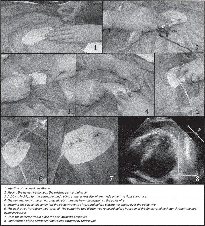 Permanent indwelling catheter for the management of refractory malignant pericardial effusion.