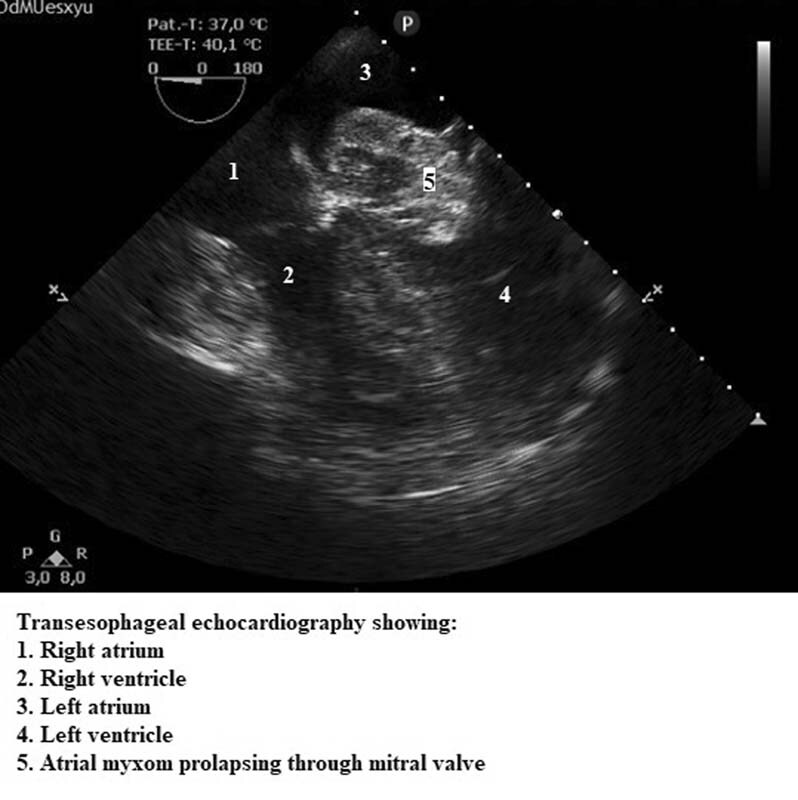 Prolapsing Left Atrial Mass Presenting as Syncope.