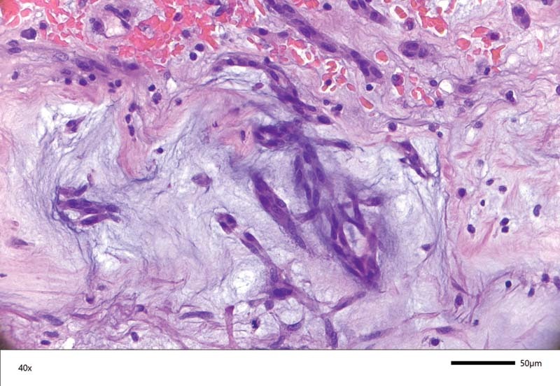 Prolapsing Left Atrial Mass Presenting as Syncope.