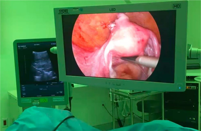 Intraoperative Laparoscopic Ultrasound Increases Fibroid Detection During Laparoscopic Myomectomy.