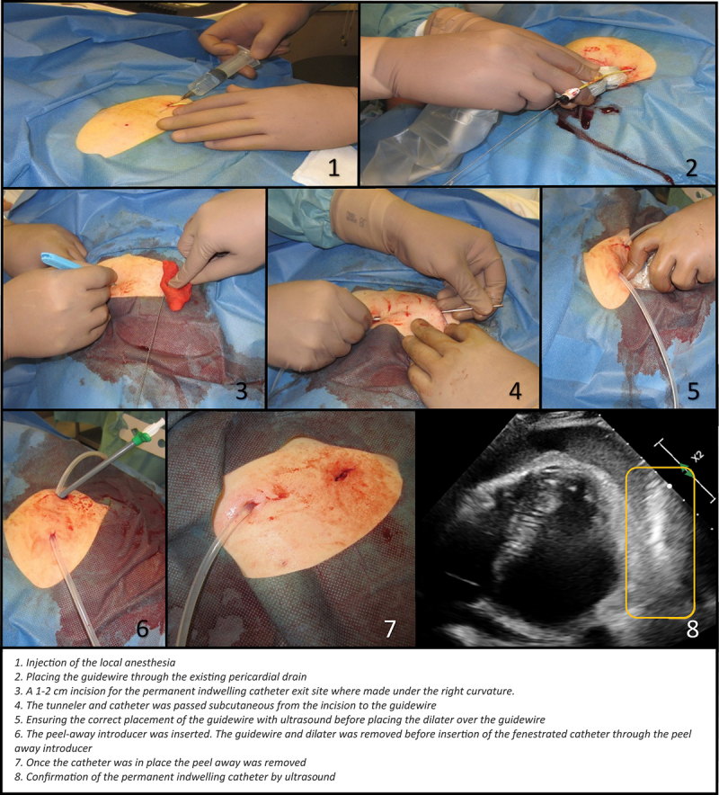 Permanent indwelling catheter for the management of refractory malignant pericardial effusion.