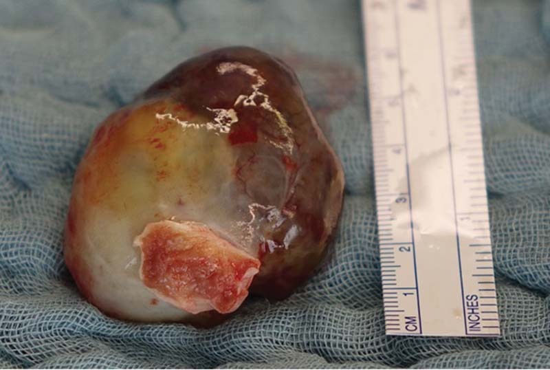 Prolapsing Left Atrial Mass Presenting as Syncope.