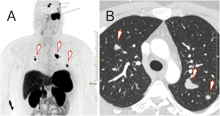 A rare case of metastatic atypical meningioma that highlights the shortcomings of treatment options at present.