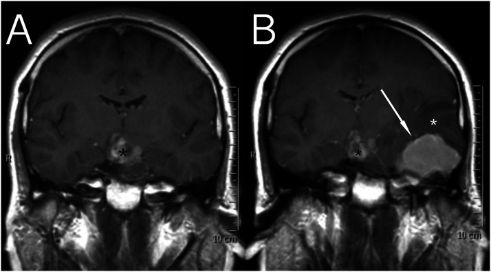 A rare case of metastatic atypical meningioma that highlights the shortcomings of treatment options at present.