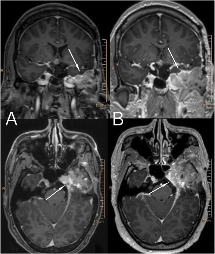 A rare case of metastatic atypical meningioma that highlights the shortcomings of treatment options at present.