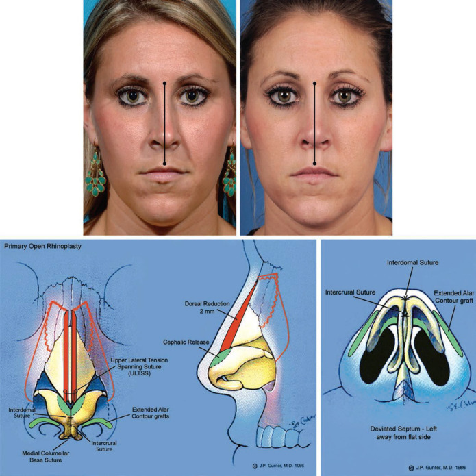 Prevalence of Facial Asymmetry and Correction Methods for Rhinoplasty in Individuals with Deviated Nose: A Brief Review.