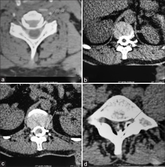 A Single-Level Epidural Blood Patch for Multiple Cerebrospinal Fluid Leaks: How it Works.