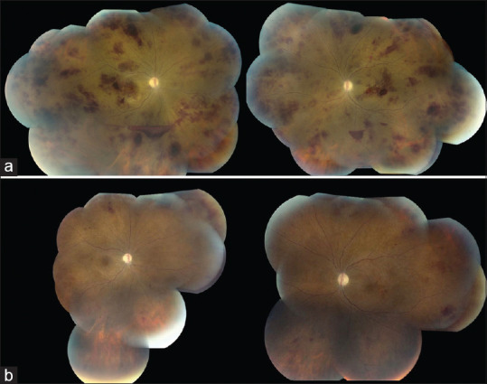 Bilateral Occlusive Retinal Vasculitis in a Patient with Dermatomyositis.