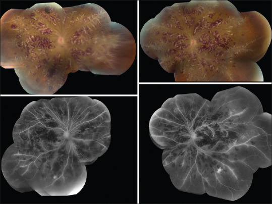 Bilateral Occlusive Retinal Vasculitis in a Patient with Dermatomyositis.