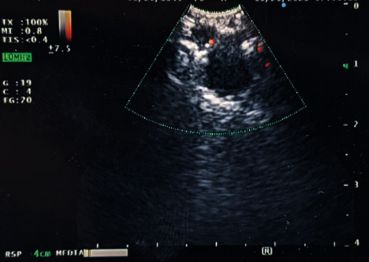 Necrotizing Granulomatous <i>Pneumocystis</i> Infection Presenting as a Solitary Pulmonary Nodule: A Case Report and Review of the Literature.