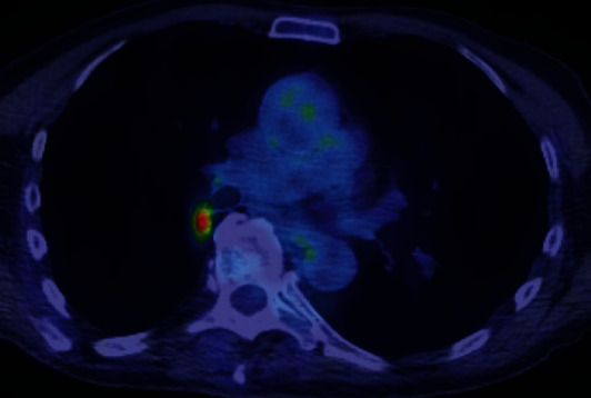 Necrotizing Granulomatous <i>Pneumocystis</i> Infection Presenting as a Solitary Pulmonary Nodule: A Case Report and Review of the Literature.