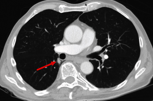 Necrotizing Granulomatous <i>Pneumocystis</i> Infection Presenting as a Solitary Pulmonary Nodule: A Case Report and Review of the Literature.