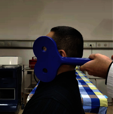 Peripheral Repetitive Transcranial Magnetic Stimulation(rTMS) for Idiopathic Facial Nerve Palsy: A Prospective, Randomized Controlled Trial.