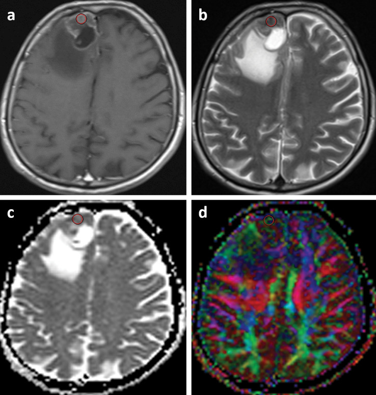 Diffusion Tensor Imaging Can Discriminate the Primary Cell Type of Intracranial Metastases for Patients with Lung Cancer.